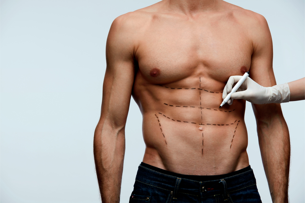 abdominoplastia-hombre-1-1024x682