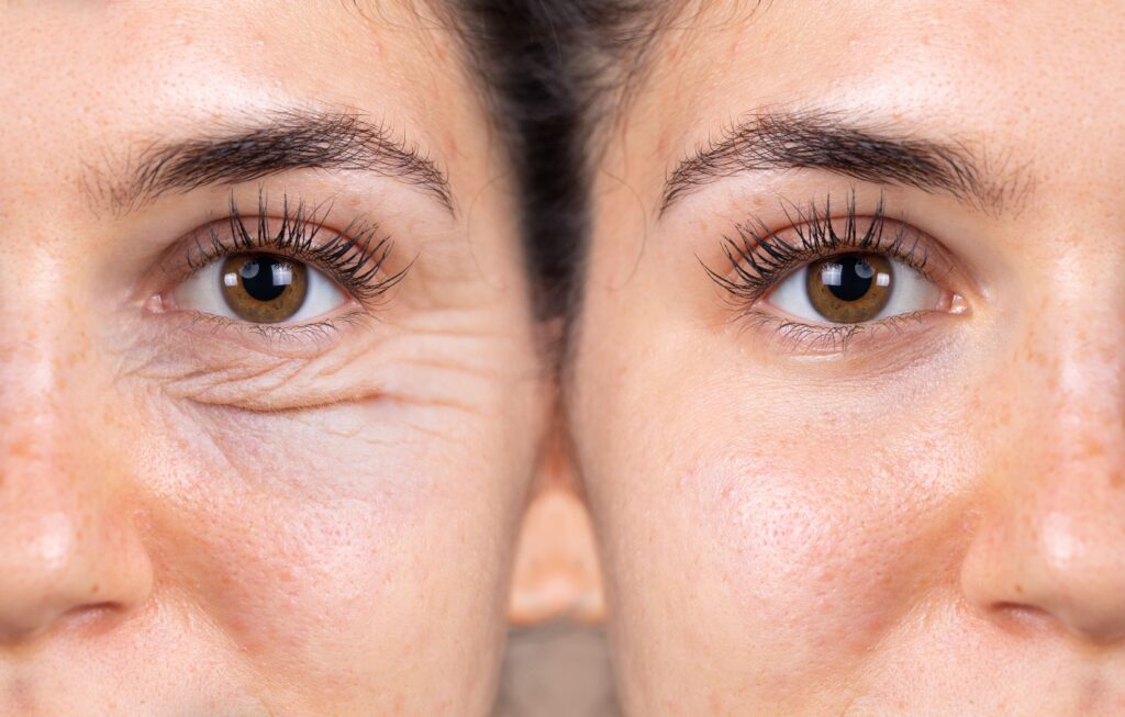 blefaroplastia-1-1024x653