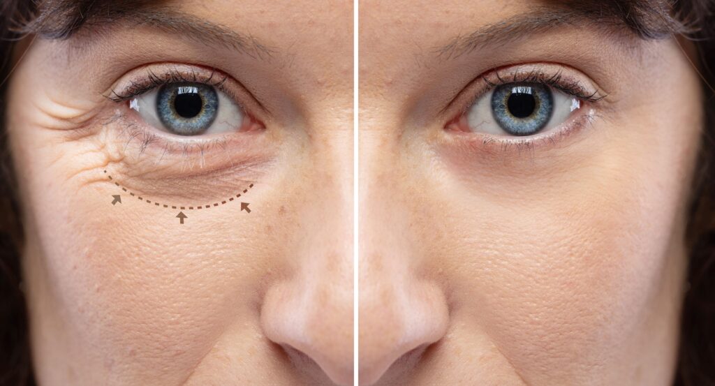blefaroplastia-2-1024x553