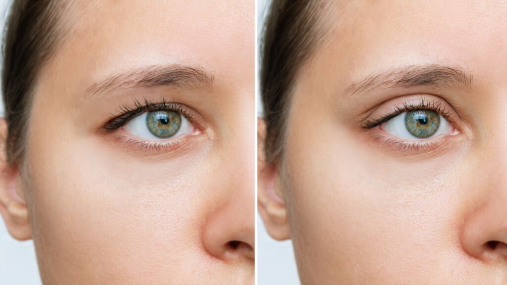 blefaroplastia-3-1024x576