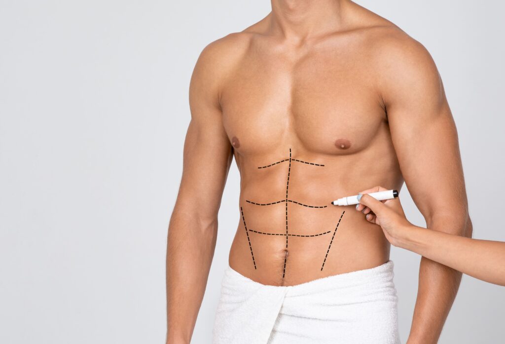 liposuccion-abdomen-hombre-1-1024x697