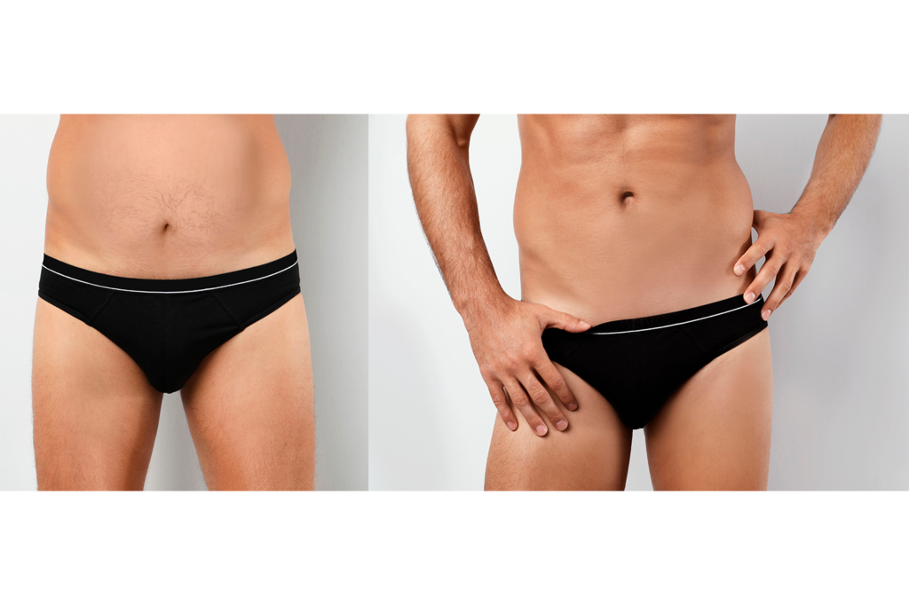liposuccion-abdomen-hombre-2-1024x682