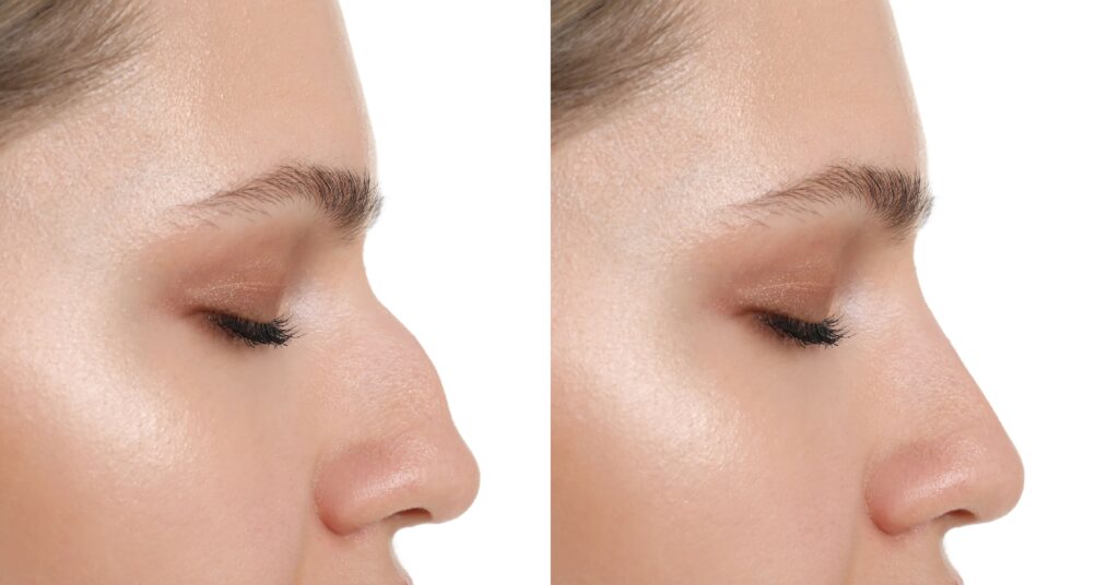 rinoplastia-4-1024x536